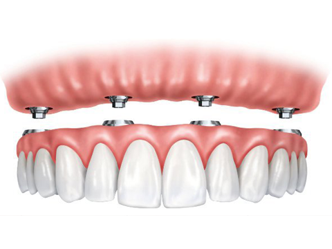 All-On-4 Implant Supported Dentures