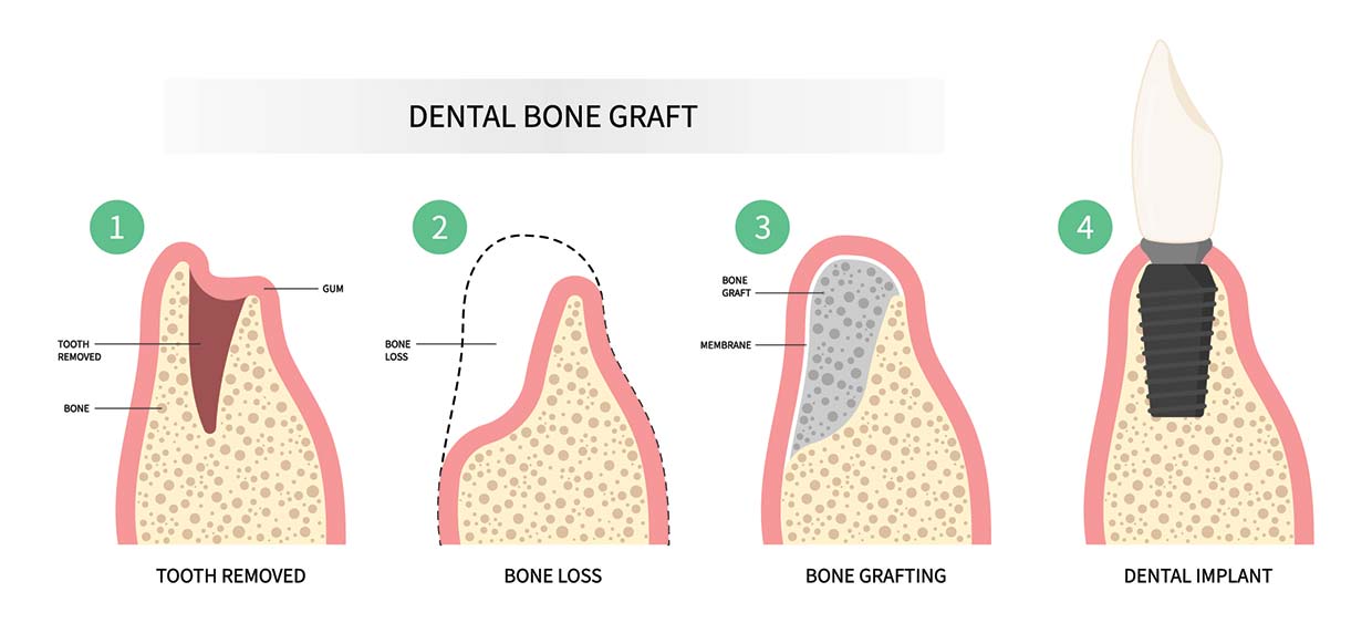 Dental Bone Graft Illustration